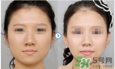 打瘦臉針疼不疼？打瘦臉針的注意事項