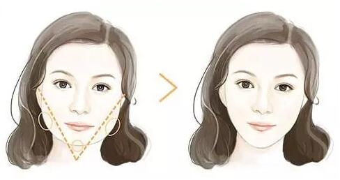 瘦臉針適合什么人打？瘦臉針適合什么臉型？