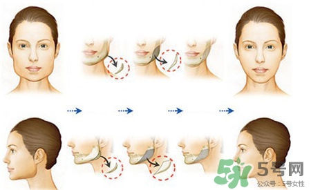 瘦臉針進口好還是國產(chǎn)好？瘦臉針國產(chǎn)和進口的區(qū)別