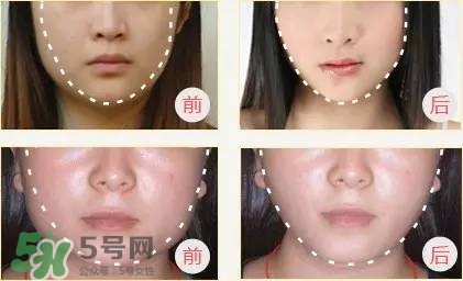 打完瘦臉針多久可以化妝？打完瘦臉針的反應(yīng)