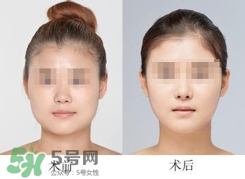 打瘦臉針能喝酒嗎？打瘦臉針能吃海鮮嗎？