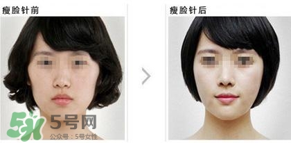 打瘦臉針能喝酒嗎？打瘦臉針能吃海鮮嗎？