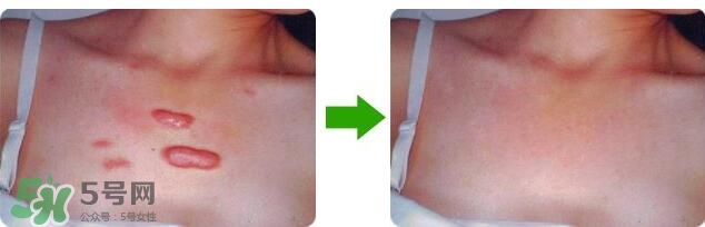 祛疤痕最好的方法有哪些？祛疤痕的簡單方法