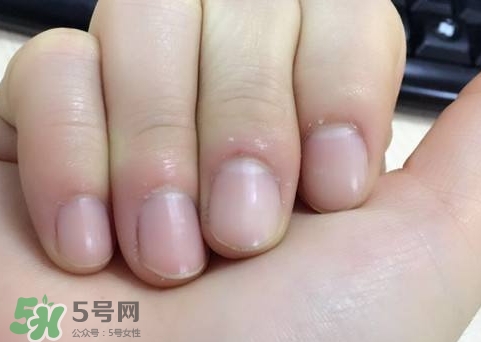 手上長(zhǎng)倒刺可以拔嗎?手上長(zhǎng)倒刺能拔嗎? 手上長(zhǎng)倒刺可以拔嗎?手上長(zhǎng)倒刺能拔嗎?