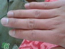 手上長(zhǎng)倒刺可以拔嗎?手上長(zhǎng)倒刺能拔嗎? 手上長(zhǎng)倒刺可以拔嗎?手上長(zhǎng)倒刺能拔嗎?