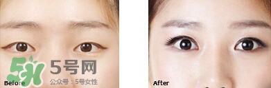 開眼角要恢復(fù)多久？開眼角好不好？