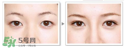 割雙眼皮有什么后遺癥嗎？割雙眼皮有什么危害性？