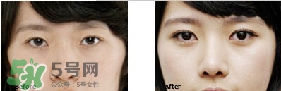 開眼角要恢復(fù)多久？開眼角好不好？