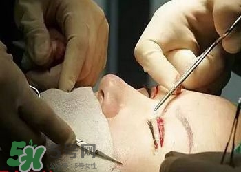 割雙眼皮疼不疼？割雙眼皮疼幾天能好？