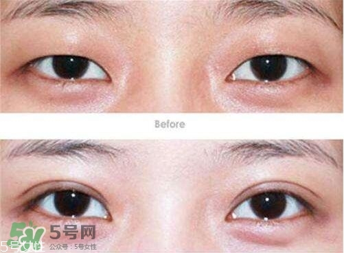 割雙眼皮有幾種做法？雙眼皮有哪幾種形狀？