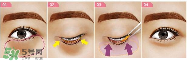 眼袋是怎么形成的？手術(shù)去眼袋安全嗎