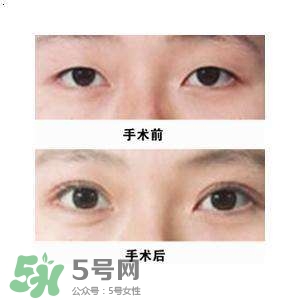 割雙眼皮疼不疼？割雙眼皮疼幾天能好？