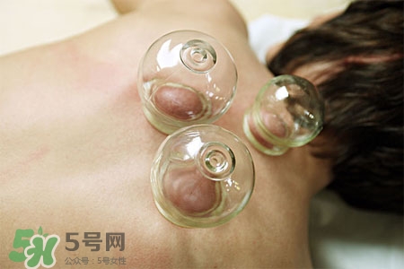 春天拔罐好不好？春天適合拔罐嗎？