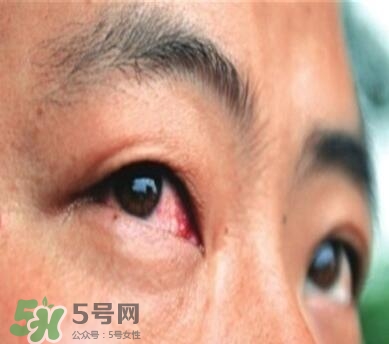 紅眼病是怎么引起的？紅眼病怎么產生的