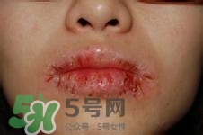 嘴唇干燥是什么原因？嘴唇干裂脫皮怎么辦？