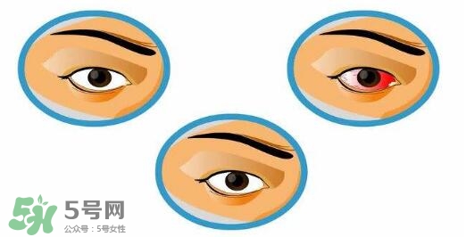 紅眼病用什么眼藥水好？紅眼病吃什么好得快