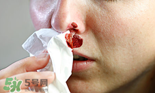一哭就流鼻血是怎么回事 流鼻血是什么原因 一哭就流鼻血是怎么回事 流鼻血是什么原因
