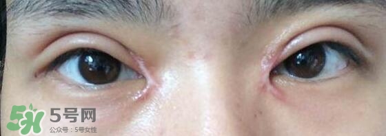 眼角增生是什么意思？眼角增生了怎么辦？