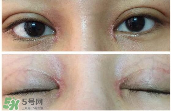 眼角增生是什么意思？眼角增生了怎么辦？