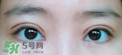 眼角增生會自動恢復(fù)嗎？眼角增生多久可以下去？