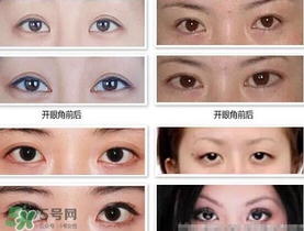 哪些人需要開眼角？需要開眼角的眼睛圖片
