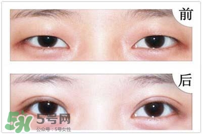 歐式雙眼皮適合什么人 歐式雙眼皮前后對比 歐式雙眼皮適合什么人 歐式雙眼皮前后對比
