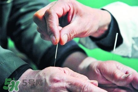 沒病可以針灸嗎？沒病可以扎針嗎？