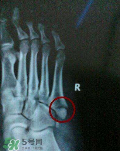 骨裂吃什么好得快？骨裂和骨折的區(qū)別