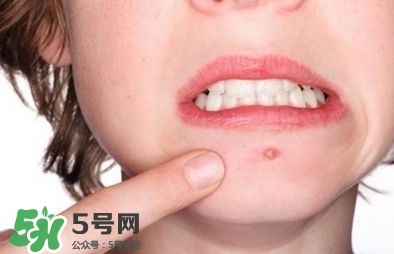 痘印怎么去除 痘印怎么祛除小妙招 痘印怎么去除 痘印怎么祛除小妙招