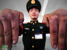 三月份還長凍瘡嗎？三月份凍瘡沒好怎么辦？