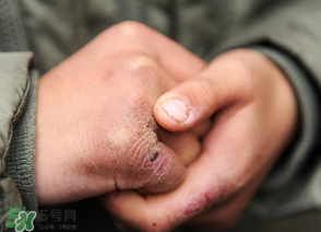 三月份還長凍瘡嗎？三月份凍瘡沒好怎么辦？