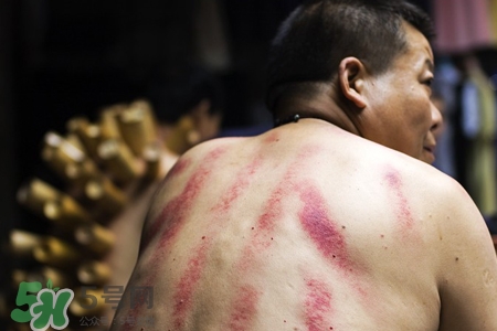 骨質(zhì)疏松可以刮痧嗎？骨質(zhì)疏松刮痧好嗎？