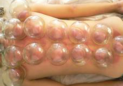 拔火罐有依賴性嗎？拔火罐依賴性強(qiáng)嗎？