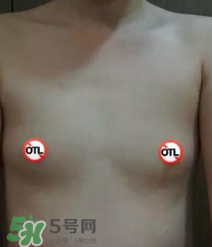 假體隆胸取出后悔死了 假體隆胸取出后圖片 假體隆胸取出后悔死了 假體隆胸取出后圖片