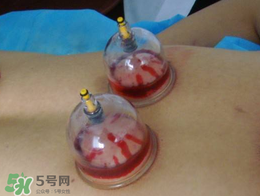 春天可以拔火罐嗎？春天適合拔火罐嗎？