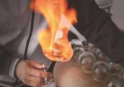 春天可以拔火罐嗎？春天適合拔火罐嗎？