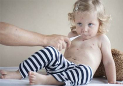 水痘隔離期為多少天？水痘的傳染期是多少天？