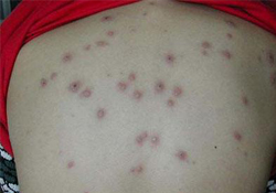 水痘會(huì)發(fā)燒嗎？小孩出水痘發(fā)燒怎么辦？