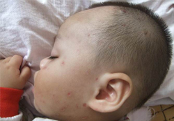 有水痘的寶寶能不能沾水？長(zhǎng)水痘可以碰水嗎？