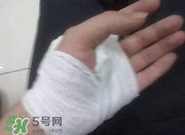 傷口化膿怎么處理？傷口化膿用什么藥好？