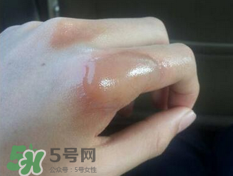 燙傷可以用牙膏嗎？燙傷用牙膏管用嗎？