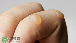 燙傷起泡要挑破嗎？燙傷起泡怎么處理？