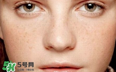 長(zhǎng)斑是什么原因引起的？祛斑效果最好的方法