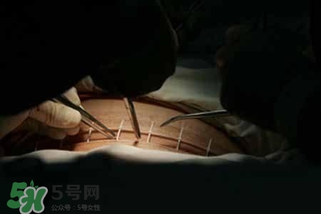 剖腹產的過程 剖腹產的步驟及時間 剖腹產的過程 剖腹產的步驟及時間