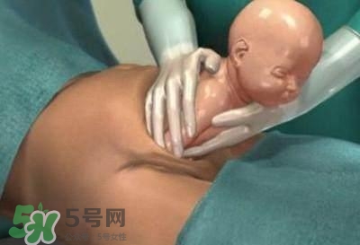 剖腹產的過程 剖腹產的步驟及時間 剖腹產的過程 剖腹產的步驟及時間
