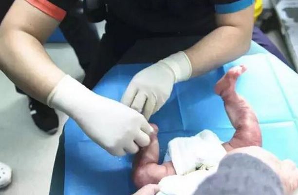 男寶寶雙腿透明 先天性皮膚缺陷是什么原因 男寶寶雙腿透明 先天性皮膚缺陷是什么原因