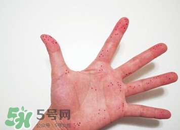 切辣椒后手很辣怎么辦？切辣椒后手很辣多久能好