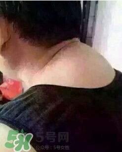 刮痧之后可以艾灸嗎？刮痧之后可不可以艾灸