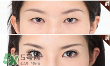 開(kāi)外眼角前后對(duì)比照_開(kāi)外眼角前后效果對(duì)比圖 開(kāi)外眼角前后對(duì)比照_開(kāi)外眼角前后效果對(duì)比圖