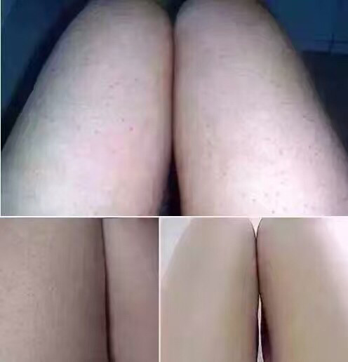 小林去雞皮膏有用嗎 小林去雞皮膏好用嗎 小林去雞皮膏有用嗎 小林去雞皮膏好用嗎